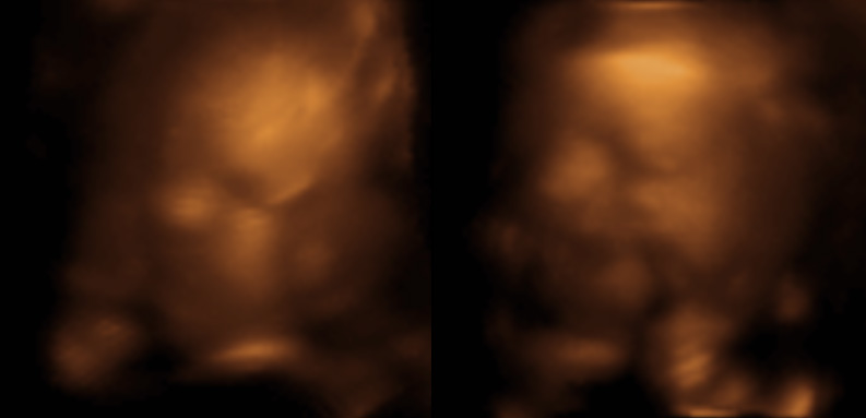 3D ultrasound